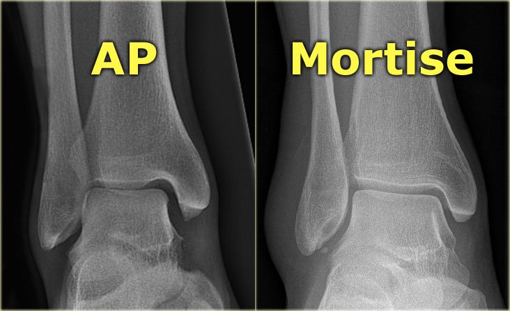 芳澤徒手保健中心 淺談案例 讓您透過案例的說明來更了解徒手保健的意義 踝關節附近常見的傷害 Part I