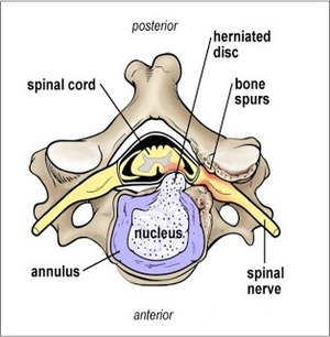 頸椎盤硬膜痛（Discodural Pain）