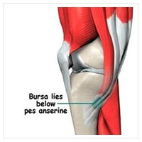 鵝掌肌滑液囊炎及肌鍵炎（Pes anserine bursitis and tendinitis）