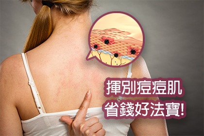 揮別痘痘肌?省錢好法寶 揮別痘痘肌?省錢好法寶