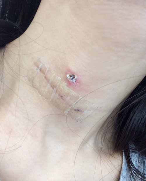 隔天换药时伤口竟然开始愈合退红