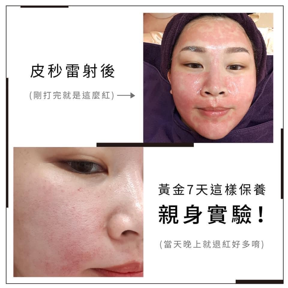 剛打完雷射，這樣保濕＋修護最適合！！