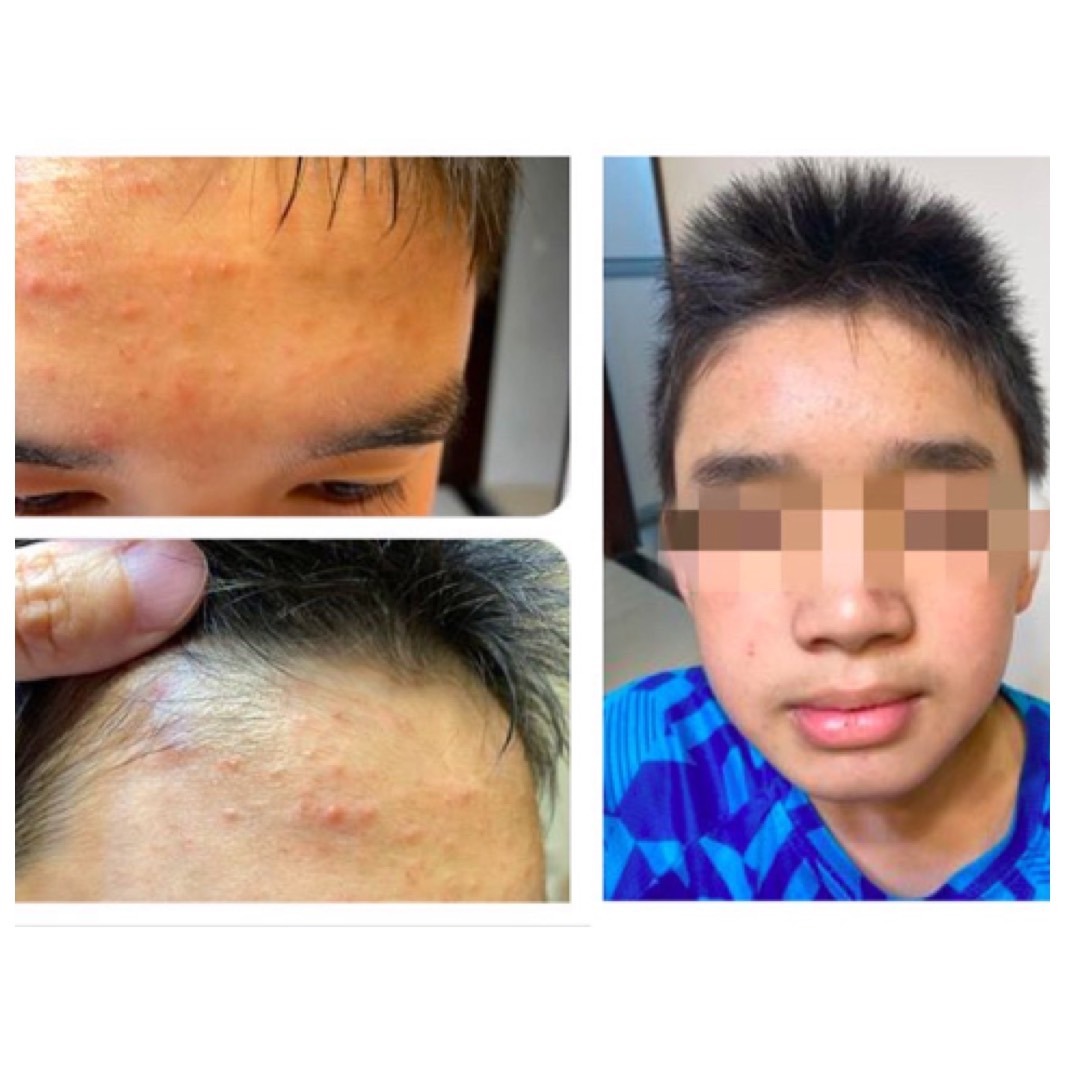 花了快兩個月,哥哥整個膚質變得很好