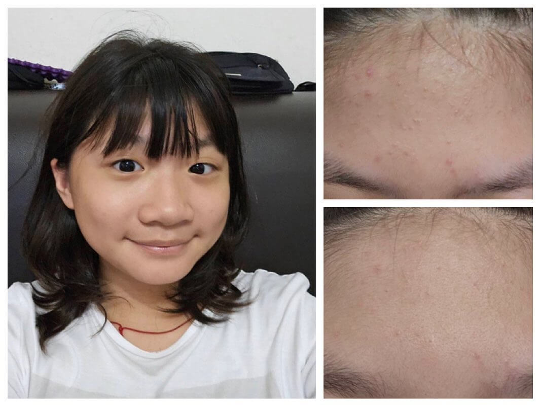 從小學三年級就一直長痘痘到國中