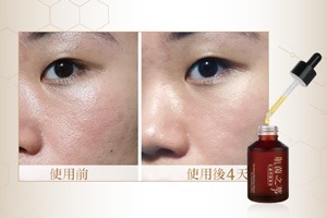 痘痘肌該如做抗痘保養?