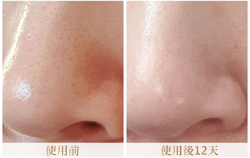 修護毛孔粗大
